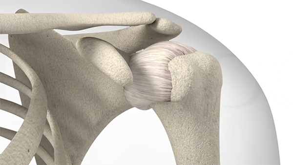 Shoulder Instability